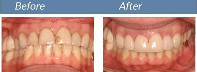 Smile transformation 6
