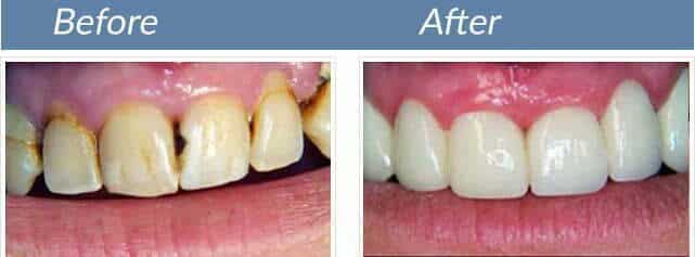Smile transformation 8