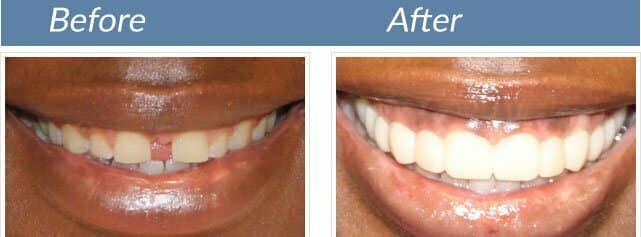 Smile transformation 4