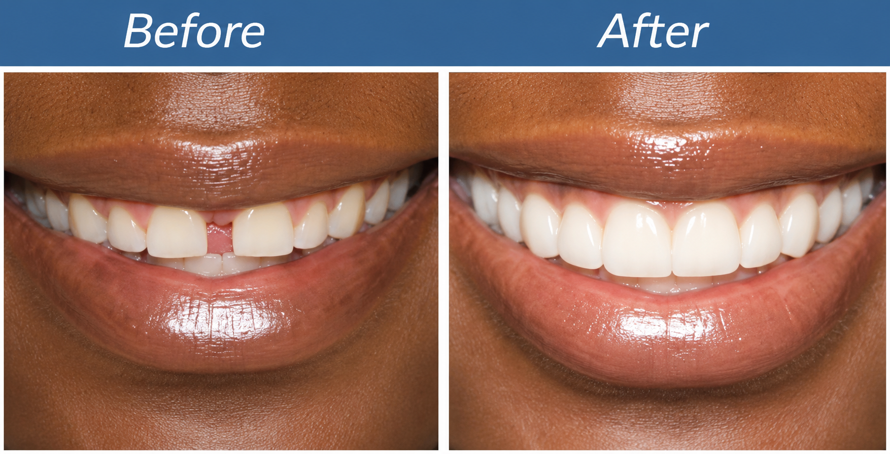 Restorative Dentistry in Houston at Uptown Dentistry