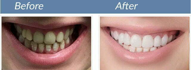 Smile transformation 5
