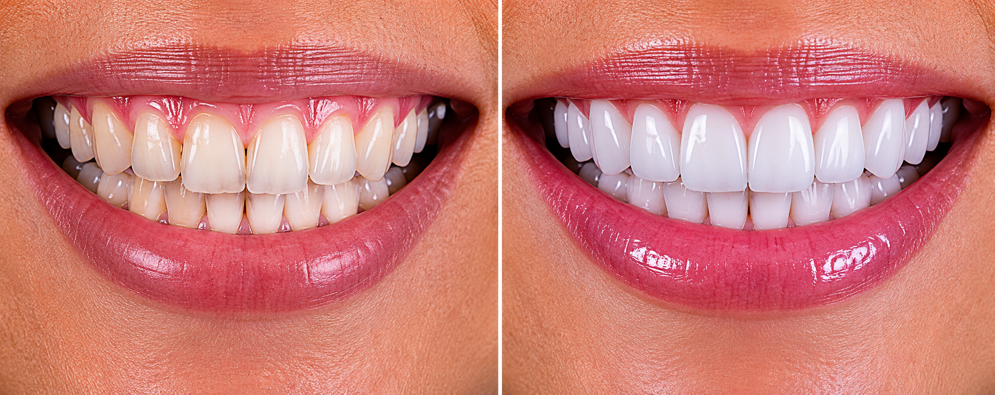 Smile transformation 1